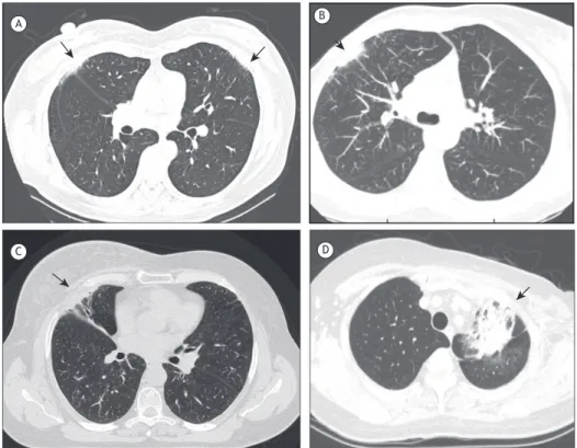 Figura 1. Imagens de TCAR mostrando características de pneumonite por radiação. Em A, imagem classiﬁ cada como  grau 1 em paciente submetida a tratamento bilateral