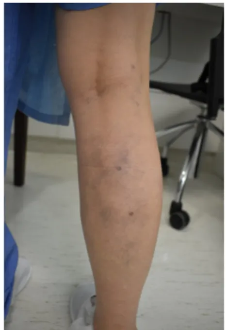 Figure 1. Preoperative photograph of the right calf.