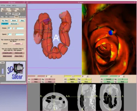 Figure 1.2: Virtual Endoscopy of the colon (virtual colonscopy) [MITa].