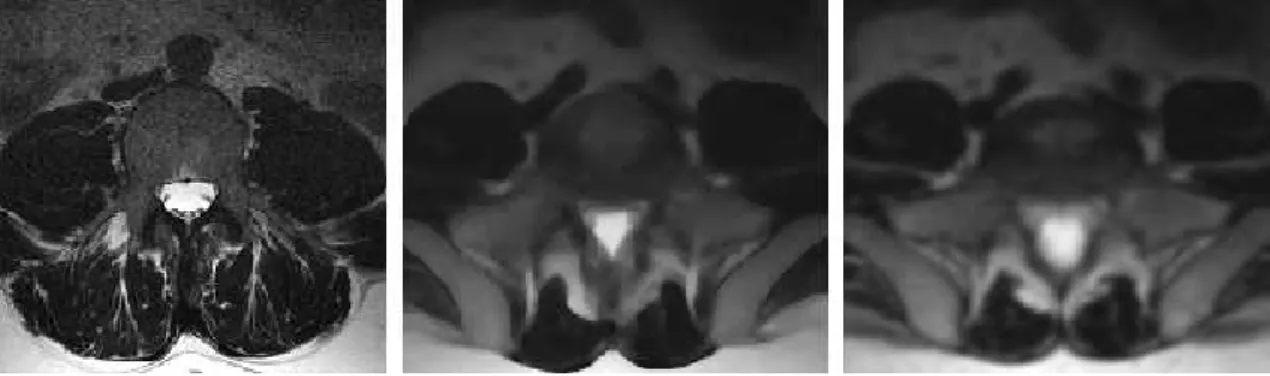 Figure 3.4: Original image (left). Use of median filter with 35 iterations and radius 1 (center), and anisotropic diffusion filter with 35 iterations and 1.0 as conductance parameter (right).