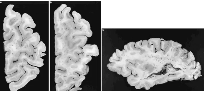 Figure 2.4: Representation of a dissected brain showing the precentral knob (indicated by arrows), which can look like an  inverted omega (A) or a horizontal epsilon (B) when cut axially, and like a hook when cut sagittaly (C) [10]