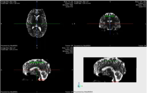 Fig. 6.9 a): Três vistas da imagem DTI, com as regiões de interesse marcadas no tronco cerebral e no  córtex