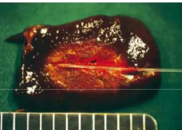 Figura 1.3 –  Lesão coagulada num fígado de porco com uma potência de 6W durante 6min (2160J) com laser de  Nd:YAG. [14] 