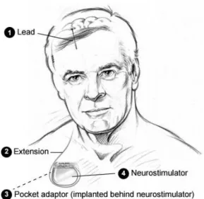 Figure 2.9: Medtronic Deep Brain Stimulation System components. Adapted from [26].