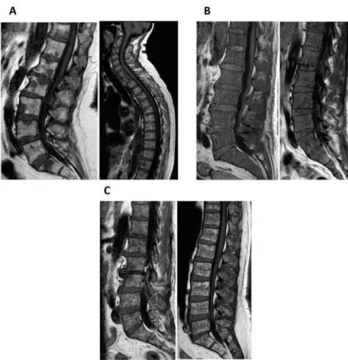 Figure 4.2: Appearances of focal, di ff use and variegated pattern on T1-weighted images.