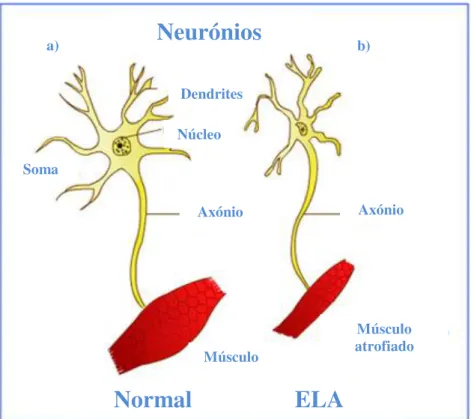 Figura 1.3 – Comparação entre a comunicação neurónio motor - músculo a) em funcionamento normal  e b) num caso de ELA