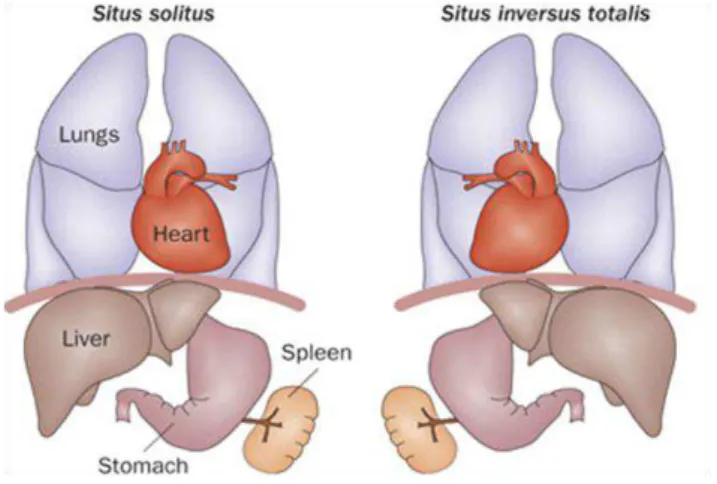 Figure 1.7  –  Organ laterality defects in PCD human patients. Normal left-right asymmetry (situs solitus) and situs inversus