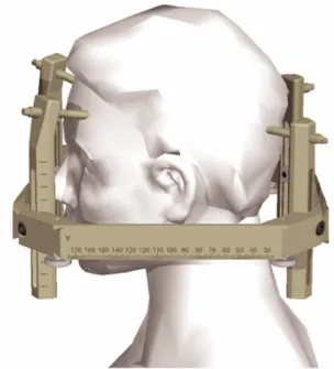 Figura 4.4: Leksell® Coordinate Frame G montado na cabe¸ca do paciente.