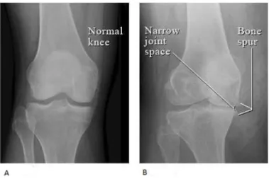 Figure 2.5: X-ray of a normal knee with space between the bone of the upper and lower leg (A)