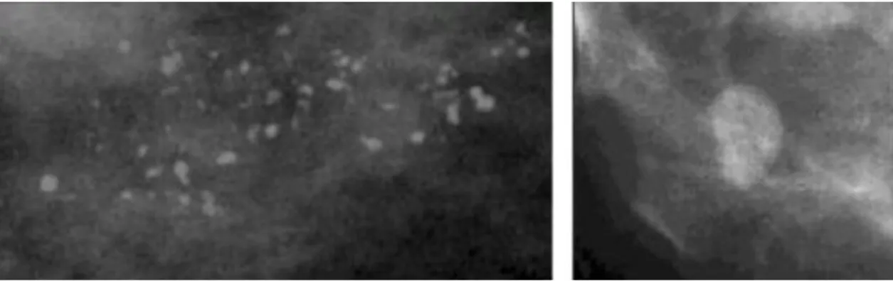 Figura 2.3 - Imagens de mamografia ampliadas mostrando algumas microcalcificações  (à esquerda) e uma massa (à direita) [32] 