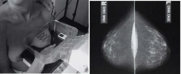 Figura 3.7 - Posicionamento e mamografia CC de ambas as mamas [58] 