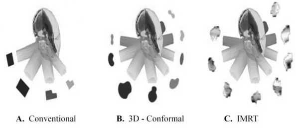 Figure 1.1: Schematic illustration of three different modalities of radiotherapy: A. 2D- conventional, B