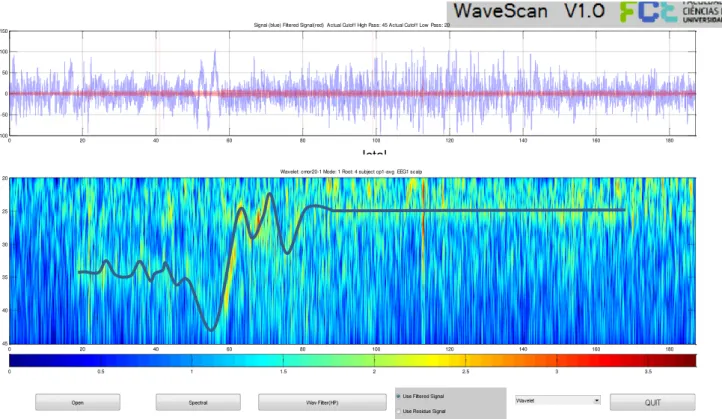 Figura 8.1.II – EEG1_Scalp CP1-avg. Cmor20-1. 1º “detalhe” high-pass45 low pass 20. 