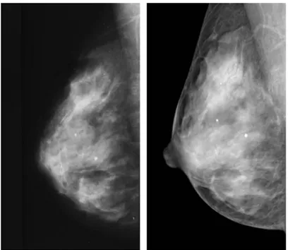 Figura 2.9 Comparação de uma imagem de mamografia convencional (esquerda) com uma imagem  de mamografia digital (direita)