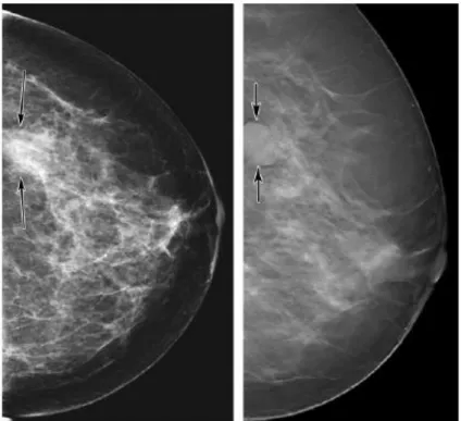 Figura 2.14 Na DBT (direita) é possível analisar com melhor exactidão uma zona suspeita em  mamografia (esquerda) [26]