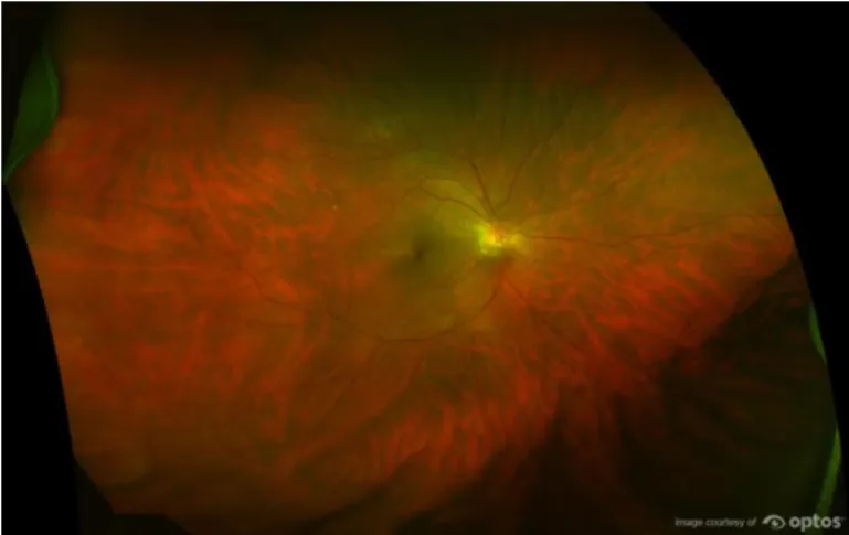 Figure 1.15 - Example of a fundus image with eyelashes and eyelids covering most of the ROI (region of interest) of  the retina