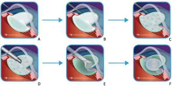 Figura 2.6: Etapas da técnica FLACS. A letra A representa a aplicação do laser para efetuar a incisão na córnea; B mostra a aplicação do laser para fazer uma abertura no saco capsular, que rodeia a catarata; C retrata a aplicação do laser para fragmentação