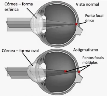 Figura 3.3: Nesta figura é evidente a diferença da córnea entre um sujeito com vista normal e um sujeito que sofra de astigmatismo, sendo que, neste último caso, a córnea apresenta um formato irregular