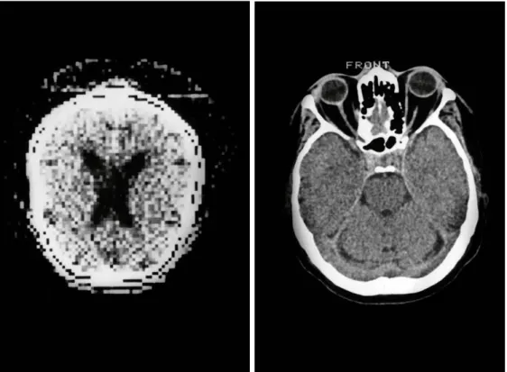 Figure 2.4: Cranial CT evolution: 1974 (left) VS 1983 (right) [11] 