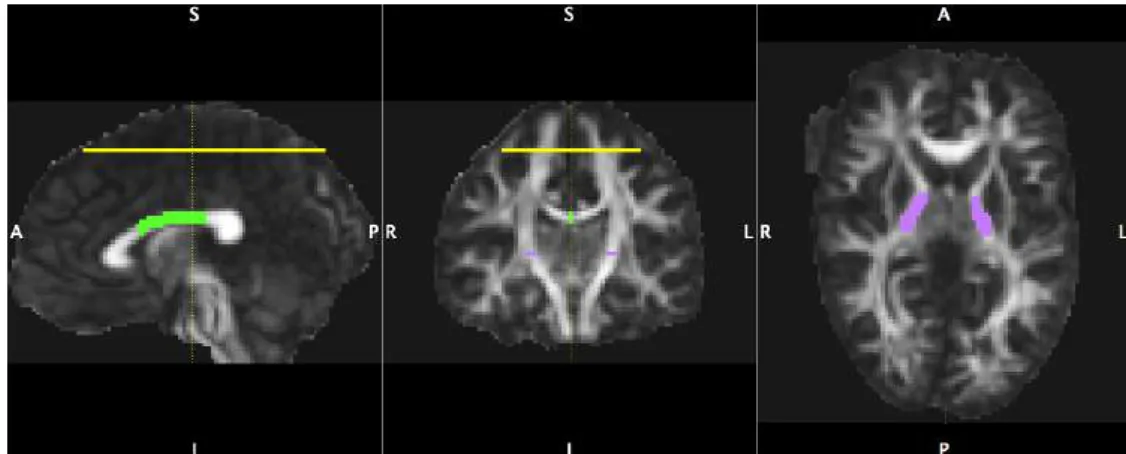 Figure 3.1: Generic placement of the ROI’s for tract isolation based on [67]. The IC ROI (purple) and the cortical regions ROI (yellow) served to isolate the CST, and the CC is isolated by considering the tracts that go through the green ROI.
