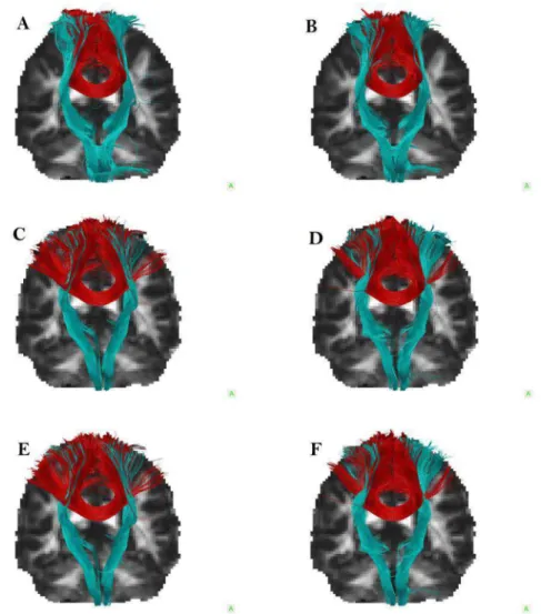 Figure 4.1: Tractography reconstructions for Subject 1. In cyan the CST tracts, red the CC tracts