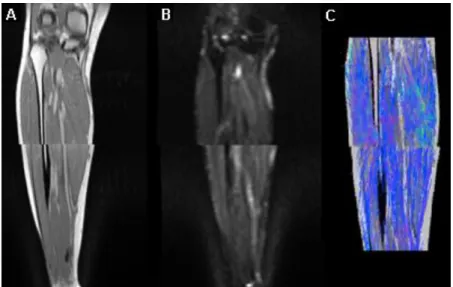 Figura 1.1 – União de dois volumes adquiridos em duas sessões contínuas sem qualquer tipo de processamento  de imagens anatómicas ponderadas a DP (A); imagens funcionais ponderadas à difusão (B); tratografia (C)