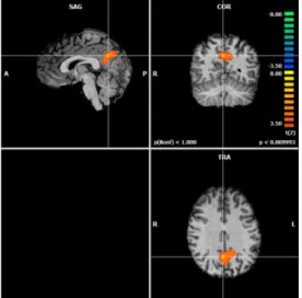 Figure  3.1:  RFX  Results.  Relevant  recruitment  of  middle temporal gyrus (BA 21) for Past Condition 