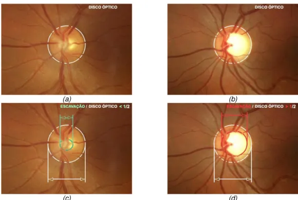 Figura 1.6: Exemplo do procedimento para diagnóstico de glaucoma em retinografias: a) e c) caso saudável e  b) e d) situação positiva para glaucoma (adaptado de (Programa Nacional para a Saúde da Visão 2012)).