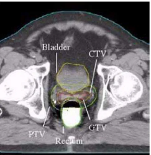 Figura  3.4  CT de planeamento de um doente com carcinoma da próstata, com o respectivo  contorno das estruturas críticas (bexiga e recto) e dos volumes-alvo (CTV, PTV e GTV)