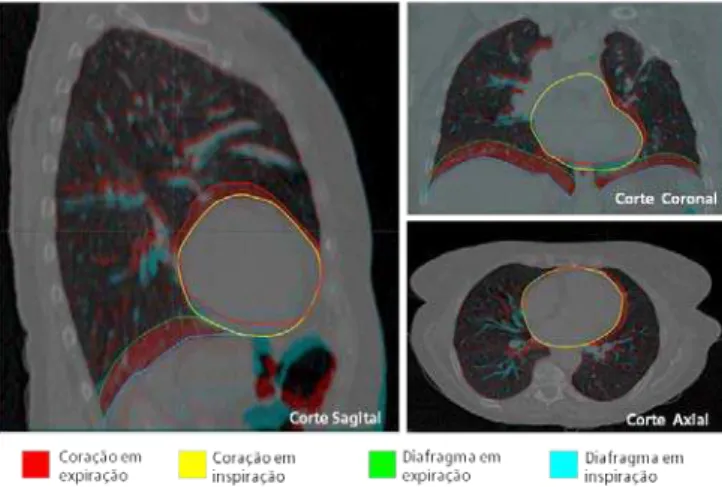 Figura 3.7 Imagens de CT representativa dos movimentos respiratórios. Adaptado de [87]