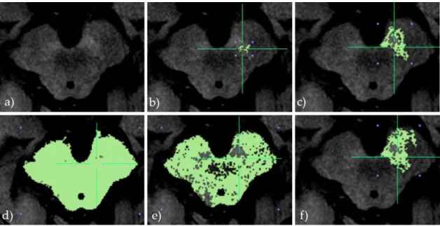 Figura 3.3: Diferentes resultados de segmentação das áreas da substantia nigra (SN) em imagens sensíveis à neuromelanina não filtradas, com a variação dos parâmetros do algoritmo Confidence.