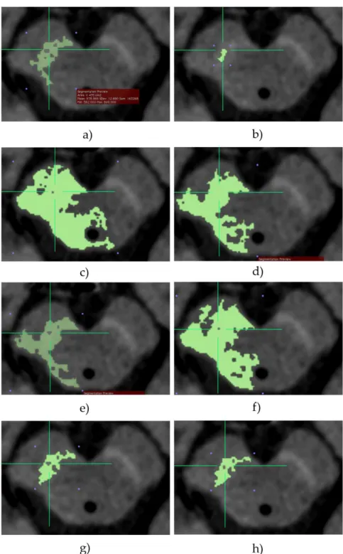 Figura 3.4: Diferentes resultados de segmentação das áreas da substantia nigra (SN), em imagens sensíveis à neuromelanina filtradas, com a variação dos parâmetros do algoritmo Confidence: (a) 2 2 1; (b) 2 1 1; (c) 3 2 1; (d) 3 1 1; (e) 2 2 3; (f) 2 2 4; (g