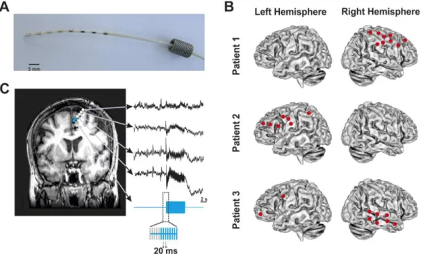 Figure 1.2: Example of multielectrode implantations and intracranial stimulation procedures