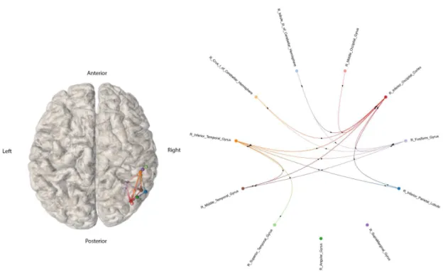 Figure 3.1: High Intensity Stimulation iEEG-based connectome, from patient reference 1998 (n=1) displayed on a normalized brain volume or as a graph, estimated with S-PLVs
