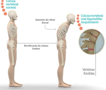 Figura 2.7: Ilustração das alterações biomecânicas da coluna vertebral em indivíduos com Espondilite Anquilosante