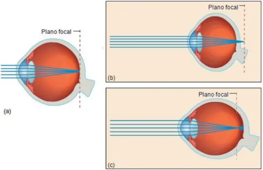 Figura 2.5: Ilustração da posição do plano focal no olho emetrope e ametrope. 