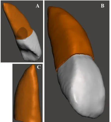 Figura 2. 6 Etapas da criação do LPD do dente 11. (A) Seleção da área onde o LPD deverá conectar a superfície  dentária; (B) execução da sobre-espessura da anterior seleção; (C) obtenção do modelo