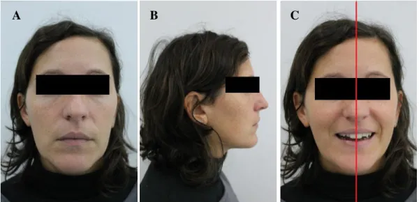Figura 2. 16  Fotografias faciais da paciente em diferentes posições: frontal em posição de intercuspidação máxima  (A), lateral direita em posição de intercuspidação (B) e frontal em sorriso com representação da linha média (C)