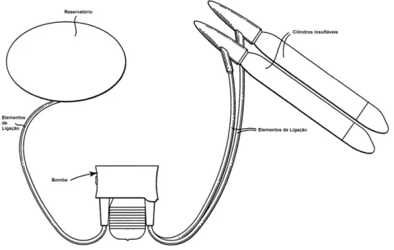 Figura 3.3: Prótese de implante peniano de 3 volumes [4] 