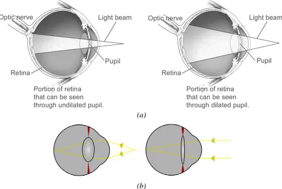 Figure 1.2 – Light propagation in the retina. (a) The light behaviour for an undilated and a dilated pupil; 