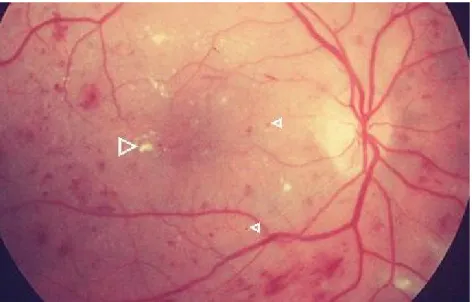 Figure 1.5 – A retina affected by Diabetic Retinopathy, where cotton wool spots (bright spots) and  haemorrhages (darker spots) are visible