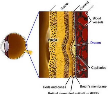 Figure 1.9 – The appearance of drusen between the Bruch’s membrane and the RPE. 