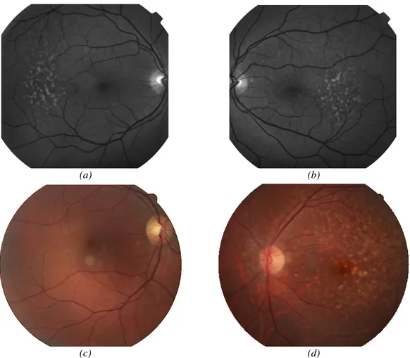 Figure 3.3 – Retinal images with analogue contrast Improvement. (a) (b) Retinal images acquired with red-free  illumination