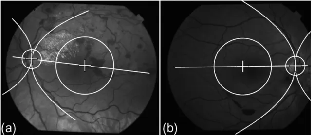 Figure 3.5 – Locating of the macula using the geometric configuration of blood vessels and optic disc