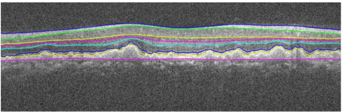 Figure 2.3: Example of the resulting segmentation of 7 layers from a pathological eye by Chiu et al