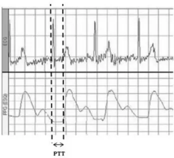 Figura 3.8 Determinação do PTT através de registo electrocardiográfico 