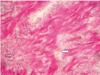 FIGURA 1. Fotomicrografia do miocárdio ventricular esquerdo  de um gato ( Felis catus ) com CMH e infarto do miocárdio