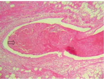 FIGURA  3.   Fotomicrografia  do  miocárdio  ventricular  esquerdo de um gato ( Felis catus ) com CMH e infarto do  miocárdio