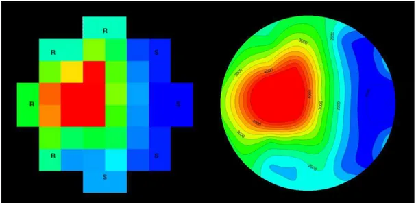 Figura 5.11 – Exemplo de tomograma ultra-sónico de um provete obtido com o GEOTOMCG (esq.) e  tomograma do mesmo provete melhorado com o SURFER (dir.) 