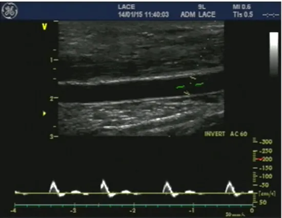 FIGURA  8  –  Imagem  da  artéria  braquial  gerada  pelo  ultrassom  e  utilizada  para  análises  de  diâmetro arterial e velocidade de fluxo